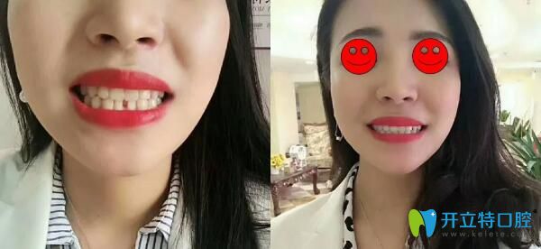 看完她在佛山壹加壹口腔做的瓷貼面效果及價(jià)格我也心動了
