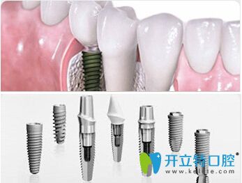 <!--<i data=20240703-sp></i>-->口腔<!--<i data=20240703-sp></i>-->醫(yī)生介紹前牙種植的優(yōu)勢