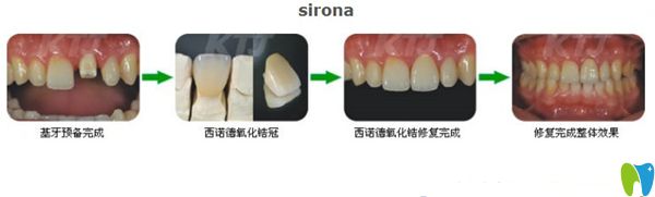 西諾德全瓷牙的制作過(guò)程