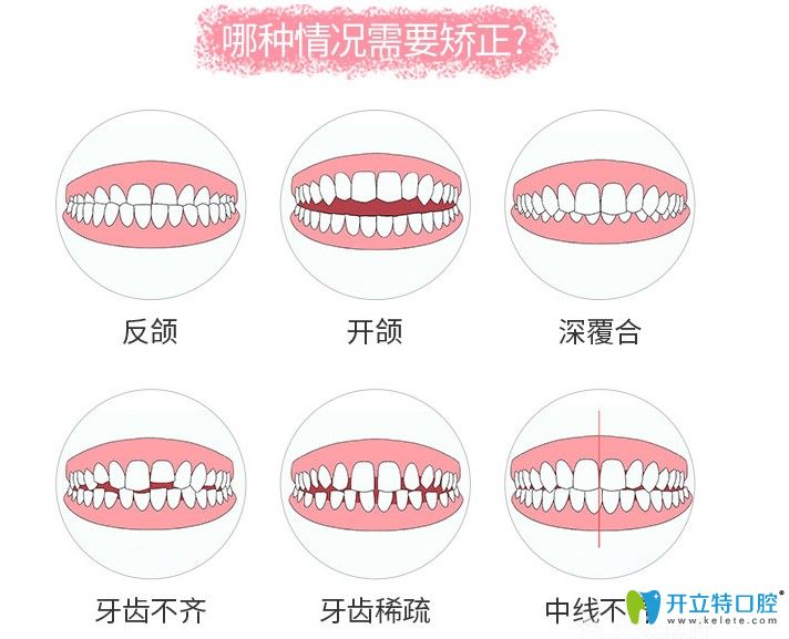 咱們來了解下哪些情況需要矯正