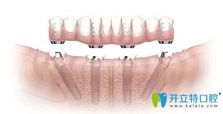 牙齒缺失帶來的三大危害 牙齒缺失帶來的三大危害