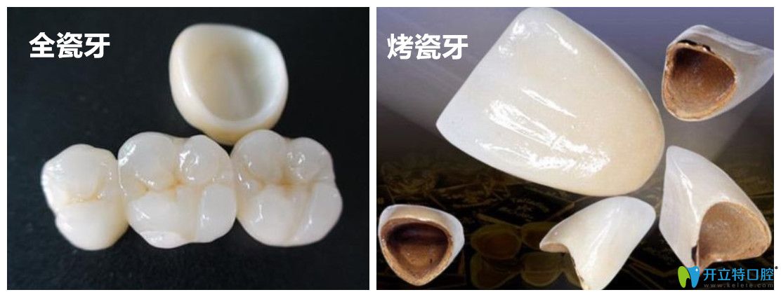 杭州烤瓷牙和全瓷牙冠多少錢?再說說全瓷牙價(jià)格高低的區(qū)別