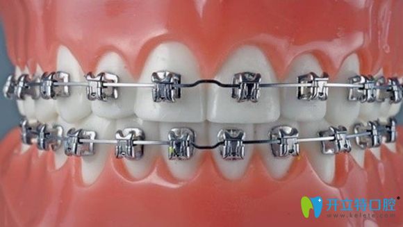 從適應(yīng)范圍和經(jīng)濟(jì)方面比較，固定矯治要比隱形矯治略勝一籌