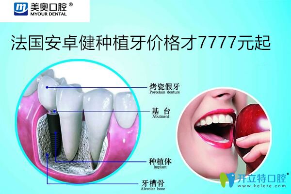忒狠！聽說上海美奧口腔法國(guó)安卓健種植牙價(jià)格7777元起