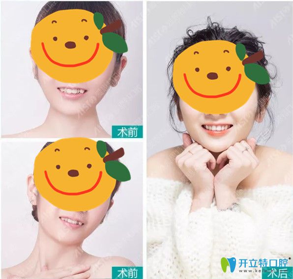 矯正后美美噠的效果圖也是愛(ài)思特口腔實(shí)力的佐證
