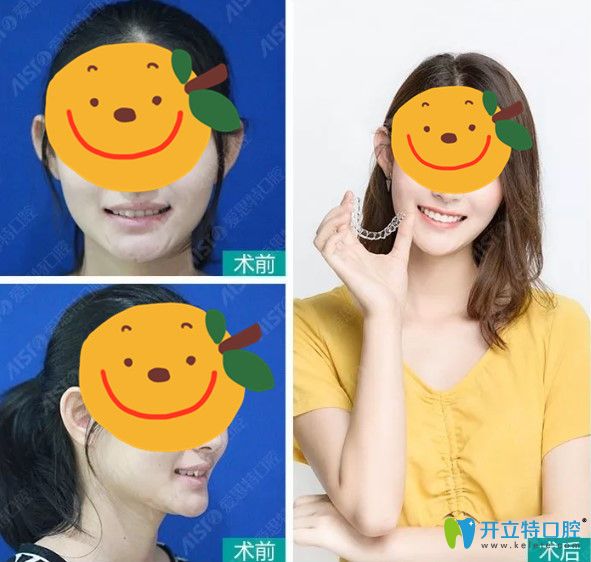 在愛(ài)思特矯正牙齒之后側(cè)臉有了小改變