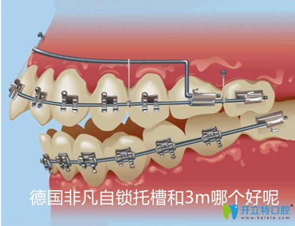 同樣身為進(jìn)口自鎖托槽品牌,德國非凡自鎖牙套和3m哪個(gè)好呢
