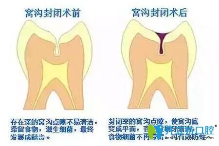 窩溝封閉