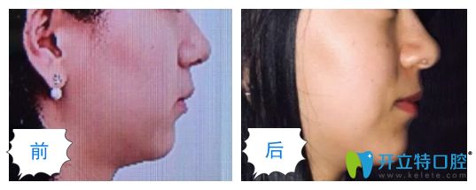 長沙美奧口腔隱形矯正虎牙臉型變化