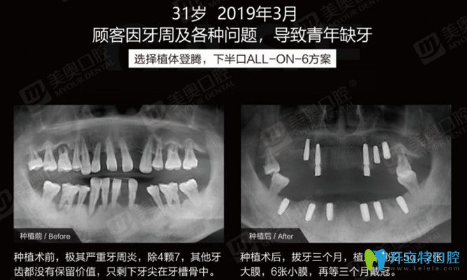 實(shí)錘！有案例證實(shí)患牙周炎照樣可以做ALL-ON-6半口種植牙
