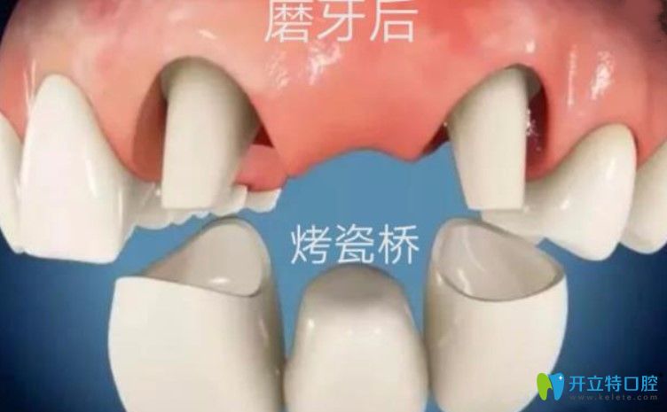 剛戴上全瓷牙咬東西疼是咋回事？趕緊戳進(jìn)來看看吧