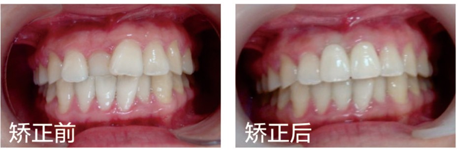 我做Ormco自鎖托槽不拔牙矯正掏了2萬多，這費用你覺得貴嗎