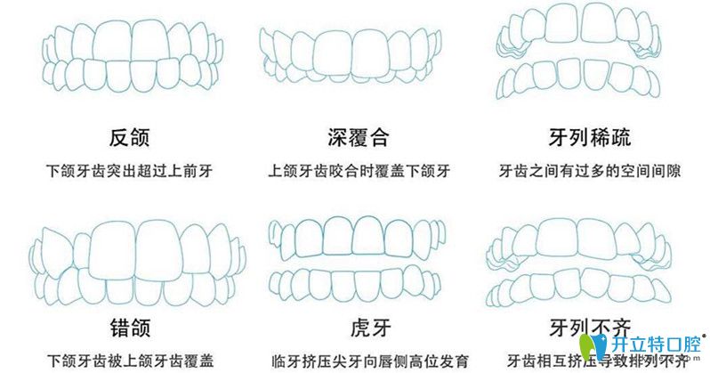 6大牙齒問(wèn)題需要做矯正