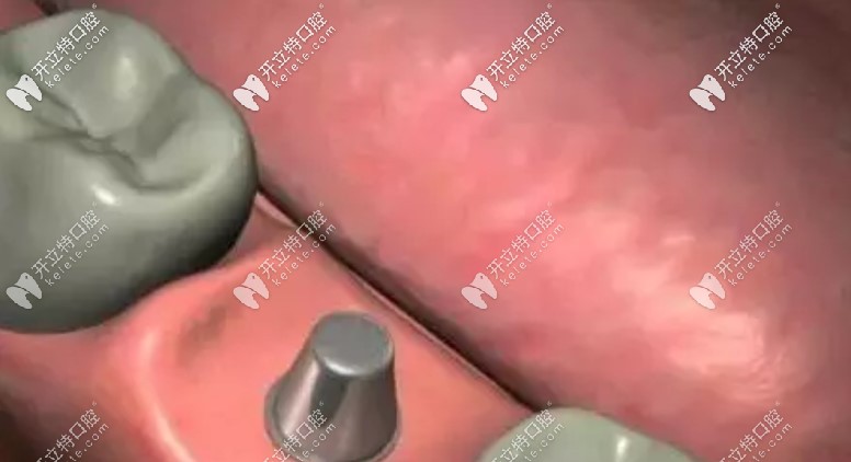 將愈合基臺換成正式基臺