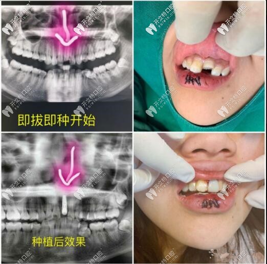 門牙磕斷不能保留，即拔即種種植牙當(dāng)天就能擁有好牙