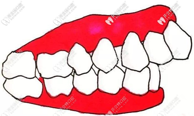 據說骨性齙牙自鎖托槽矯正用方絲比圓絲好,二者區(qū)別在哪？