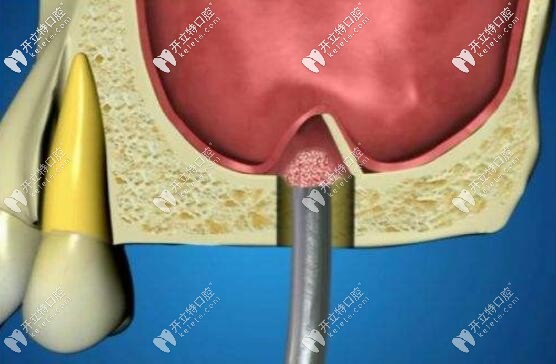 上頜竇提升術(shù)