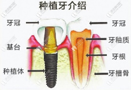 中山香山口腔醫(yī)院復活節(jié)種牙活動