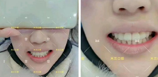 直到多生牙把門牙都擠變形了，才決定拔牙帶3M自鎖牙套矯正