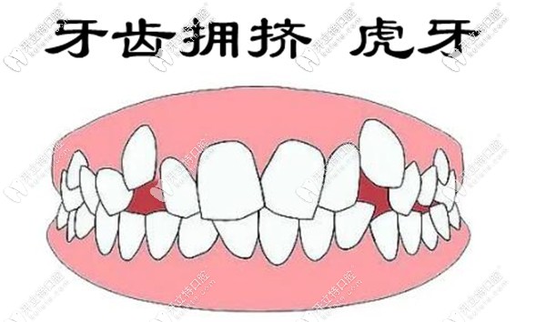 虎牙矯正可以用透明牙套嗎 虎牙矯正可以用透明牙套嗎