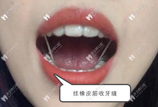 虎牙戴隱形牙套2年的效果 虎牙戴隱形牙套2年的效果