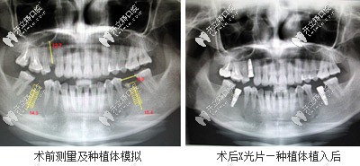 口內模擬種植