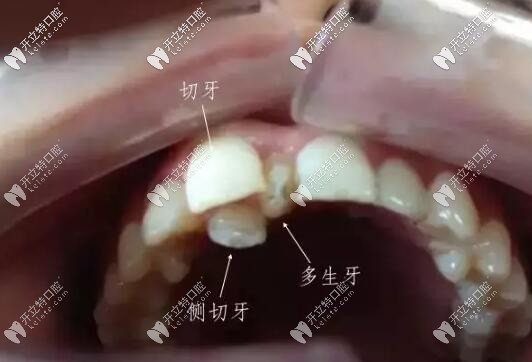 多生牙導(dǎo)致牙列擁擠