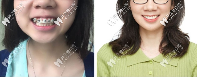 爆我箍牙前后臉型對(duì)比照?qǐng)D，你還覺得門牙外凸沒必要矯正