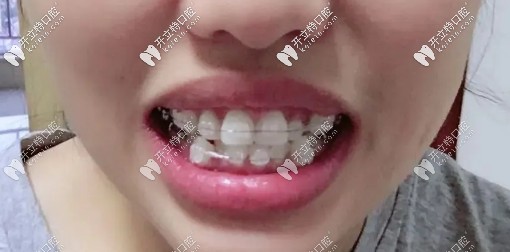 戴陶瓷自鎖托槽中期，牙齒已經(jīng)開始慢慢歸位