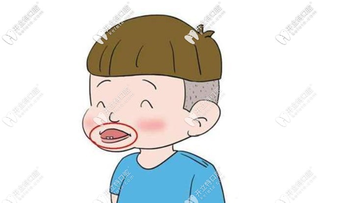  嫌羅慕矯治器與mrc麻煩，簡便的嘟嘟嘴訓(xùn)練器你可不能錯(cuò)過