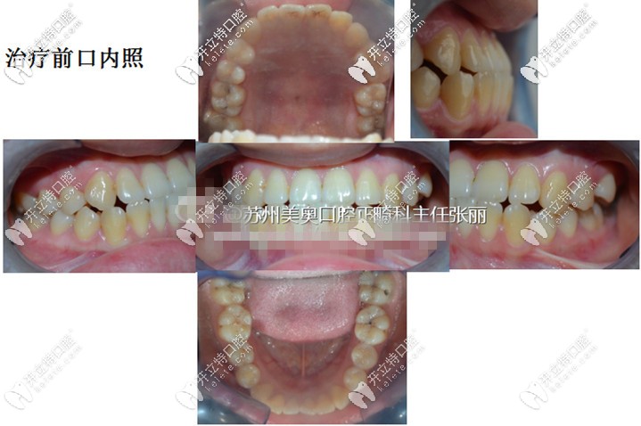 附上治療前的口內(nèi)照——上頜、左側(cè)面和右側(cè)面、下頜