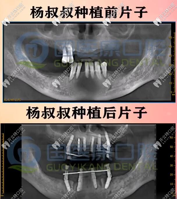 71歲楊叔做一日得全口種植牙種了10顆植體，上半口6下半口4