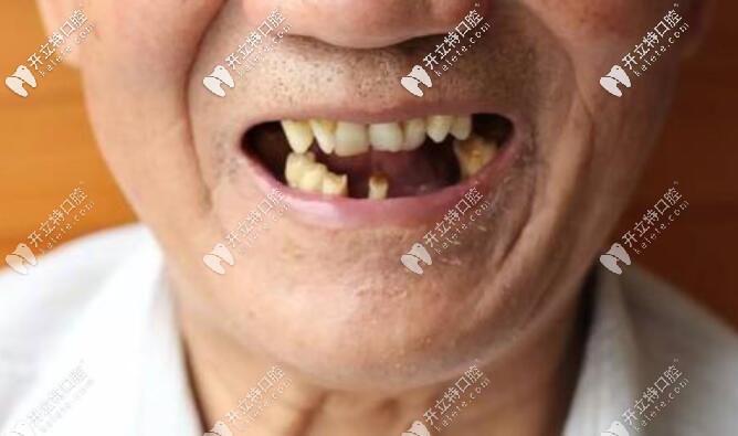 孫玉楓說70、80歲老人種牙好還是鑲牙好