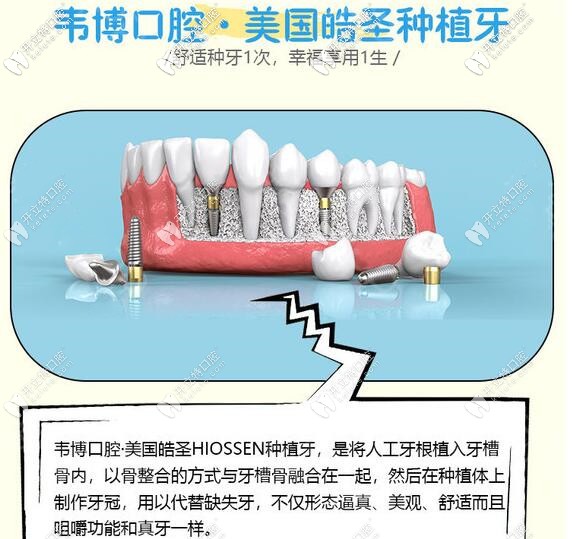 下沙韋博口腔美國(guó)皓圣種植牙價(jià)格