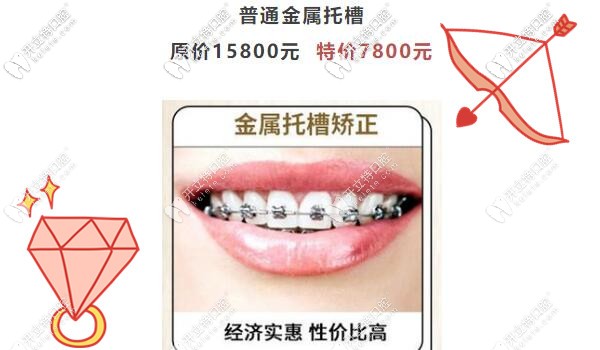 廣州圣貝傳統(tǒng)金屬托槽矯正才7800元啦,暑假正畸不造起來(lái)嗎？