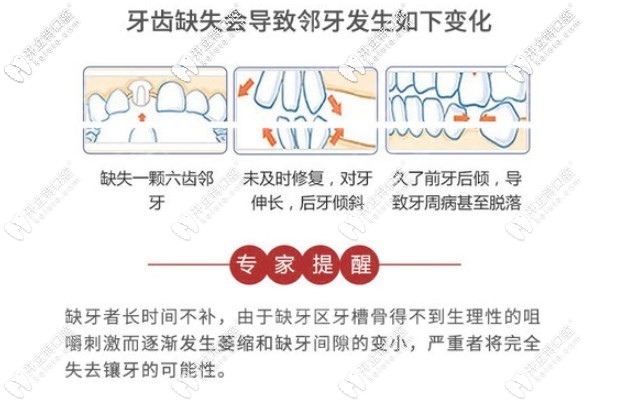 牙齒缺失，千萬(wàn)不要輕忽