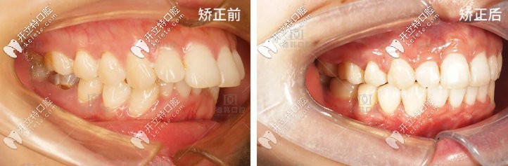 彈出一則齙牙矯正后臉型變化圖,歐巴覺得正畸兩萬(wàn)元花的值