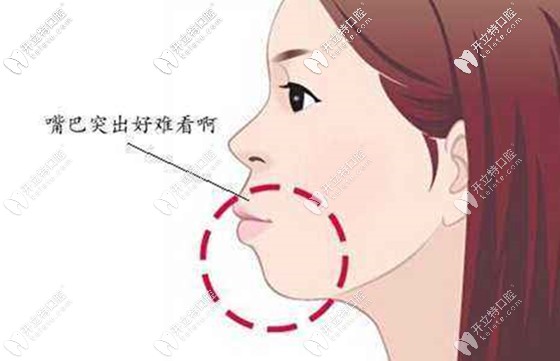 我就是這種齙牙突嘴癥狀