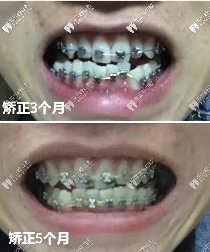 東莞固德口腔矯正牙齒怎么樣