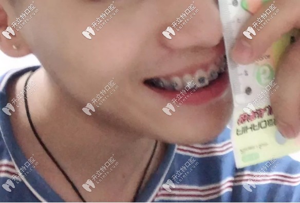 真是后悔沒早點做深覆蓋矯正