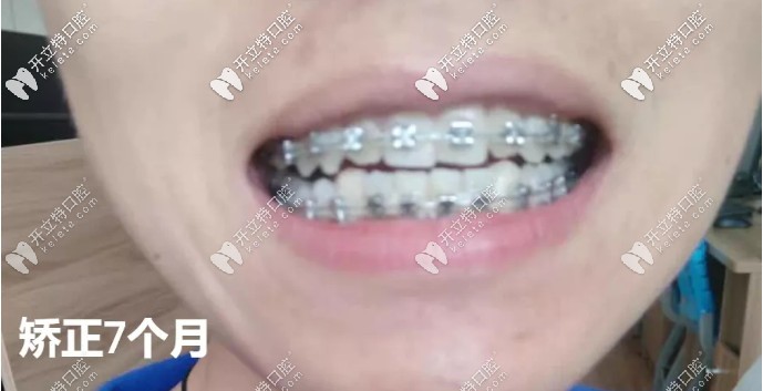東莞固德口腔做牙齒矯正的價格