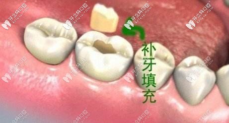 3M納米樹脂補牙各型號的區(qū)別及用途