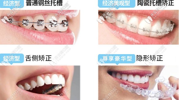 牙齒矯正的類(lèi)型