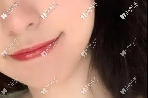 雖說還沒結(jié)束，但嘴巴已經(jīng)變好看了哦