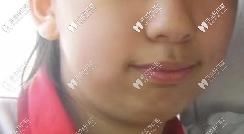 門牙突出導(dǎo)致口呼吸，下巴后縮的問題
