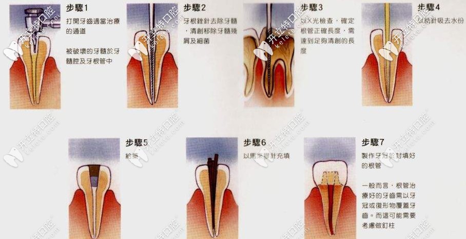 根管治療的全部過(guò)程