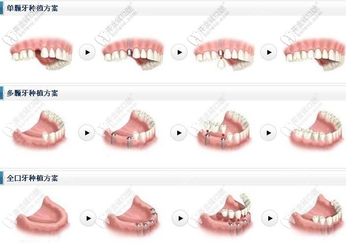 登騰種植體適合各種缺牙問(wèn)題