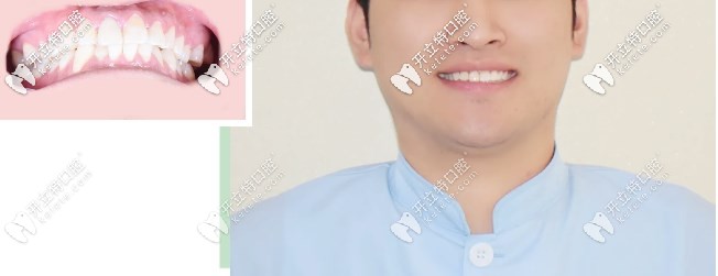 正畸醫(yī)生牙齒前凸戴隱適美隱形矯正，告訴你你不知道的事