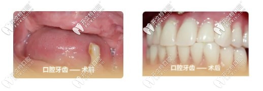 我75歲沒牙去做了全口all-on-4種植牙的經(jīng)歷，種牙過程很快
