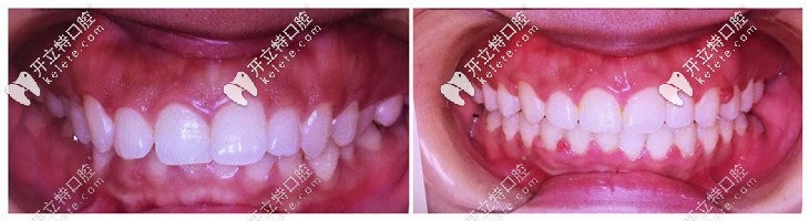 我做了Angelalign隱形矯正牙齒效果還不錯(cuò)，花多少錢都值得